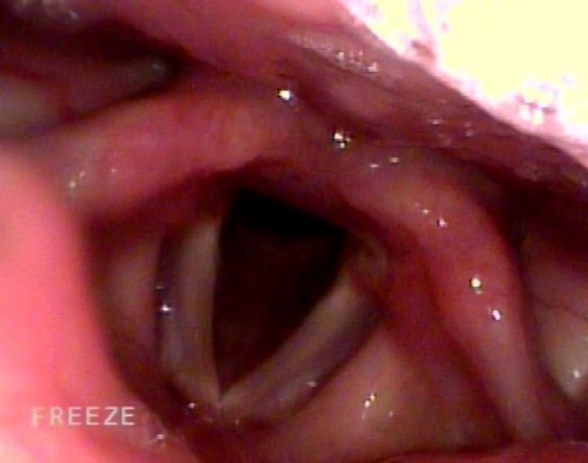 喉頭ファイバースコープ